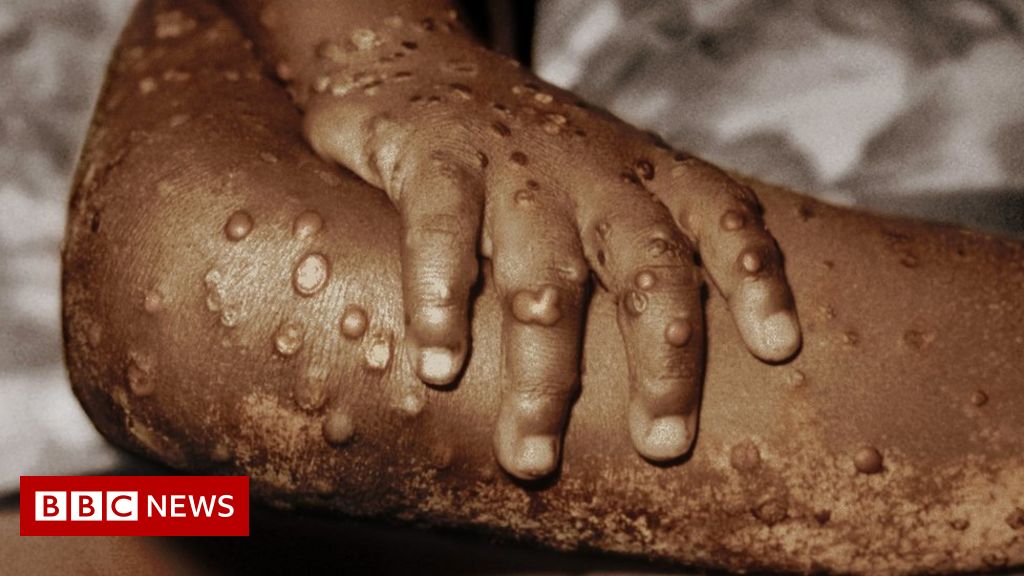 monkeypox:-80-cases-confirmed-in-12-countries